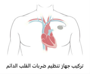 تركيب جهاز تنظيم ضربات القلب الدائم