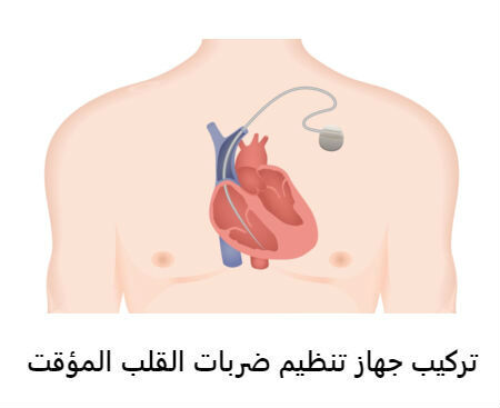 تركيب جهاز تنظيم ضربات القلب المؤقت