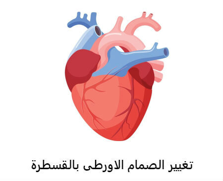 تغيير الصمام الاورطى بالقسطرة