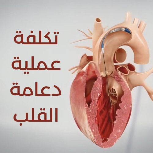 تكلفة عملية دعامة القلب