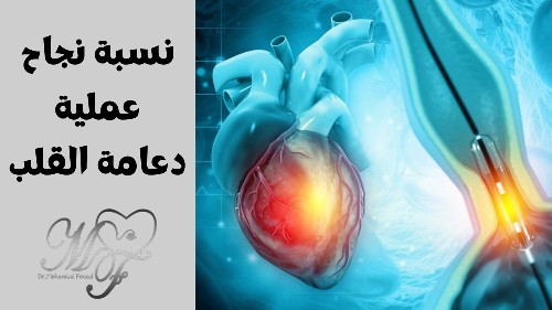 كم نسبة نجاح عملية قسطرة القلب