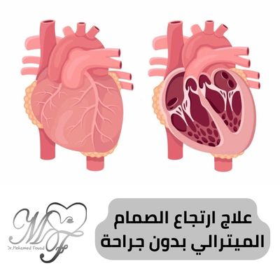 علاج ارتجاع الصمام الميترالي بدون جراحة