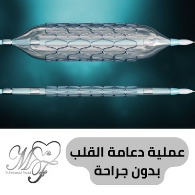عملية دعامة القلب بدون جراحة 2025