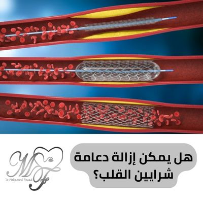 هل يمكن إزالة دعامة شرايين القلب |3 حالات تحتاج لعملية إزالتها
