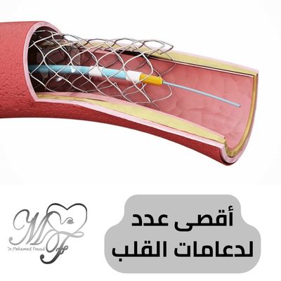 أقصى عدد لدعامات القلب | قد يصل الى 6 دعامات