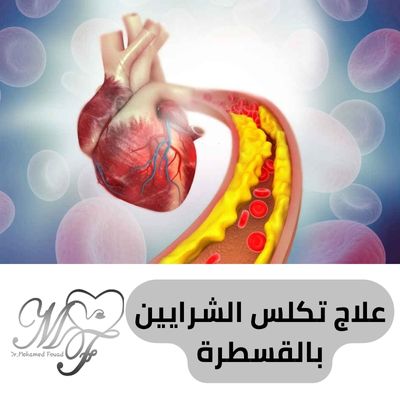 علاج تكلس الشرايين بالقسطرة 2025