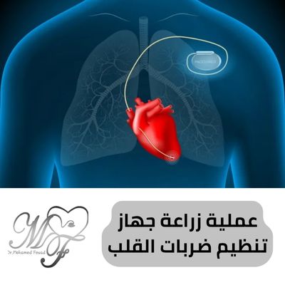 عملية زراعة جهاز تنظيم ضربات القلب | مدة بقائه من 7 الى12 سنة