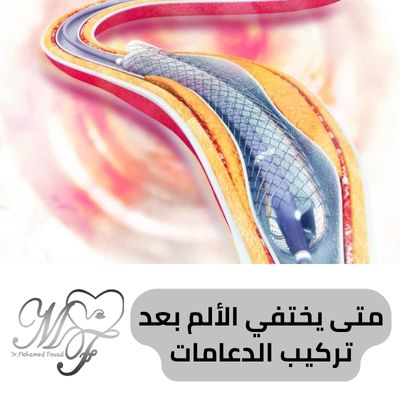 متى يختفي الألم بعد تركيب الدعامات | 4 عوامل تؤثر في المدة